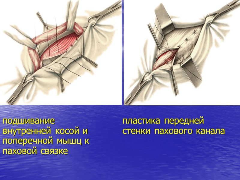 подшивание внутренней косой и  поперечной мышц к  паховой связке пластика передней стенки